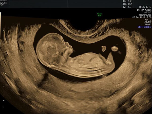 12～14週の胎児の4Dエコー3