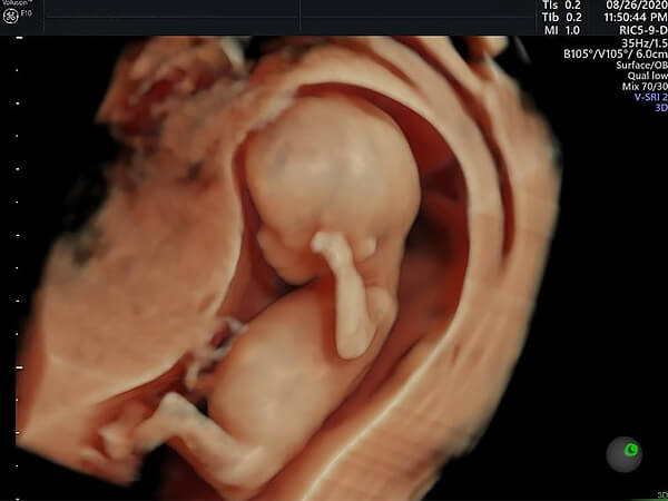 12～14週の胎児の4Dエコー4