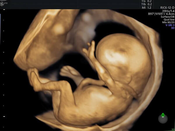 12～14週の胎児の4Dエコー5