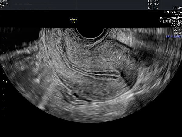 正常な子宮　経腟超音波の画像