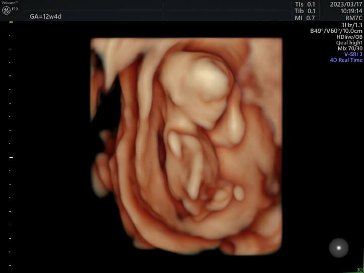 12～14週の胎児の4Dエコー1