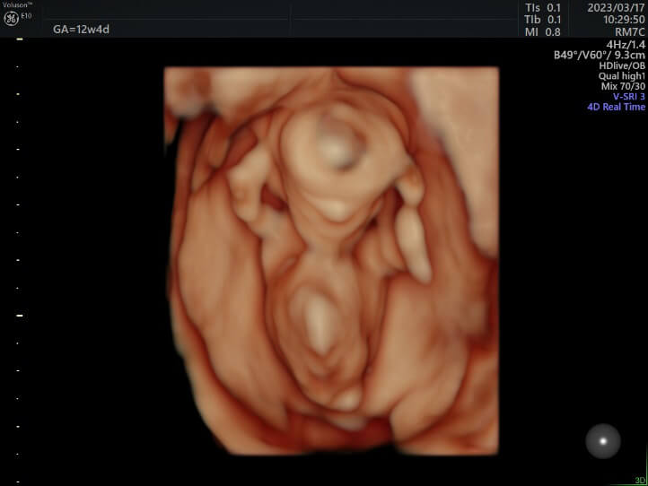 12～14週の胎児の4Dエコー2